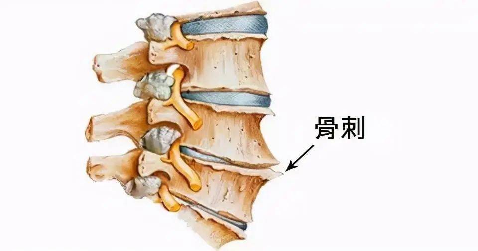 骨质增生怎么治疗：全面分析和治疗方案