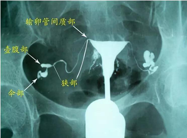 输卵管造影怎么做？详解流程、风险及术后护理