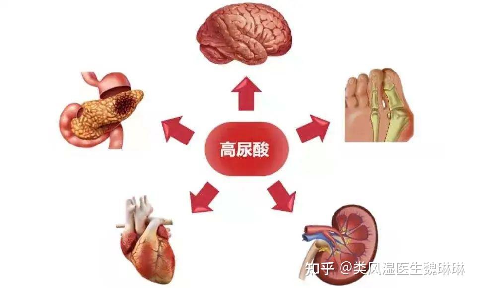 尿酸高怎么办？深度解析高尿酸血症的防治策略及生活调理