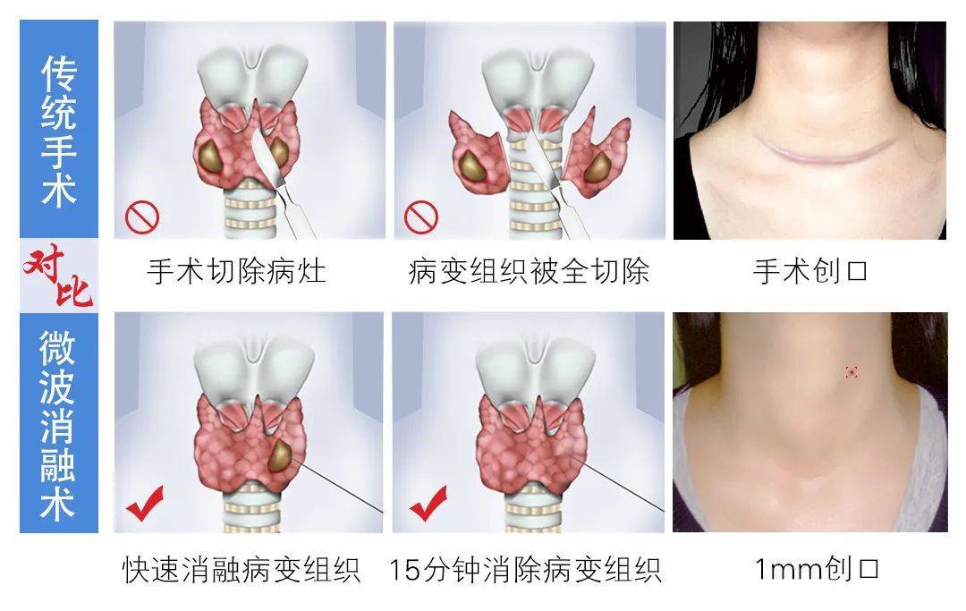 甲状腺结节怎么治疗？权威指南详解各种治疗方案及风险