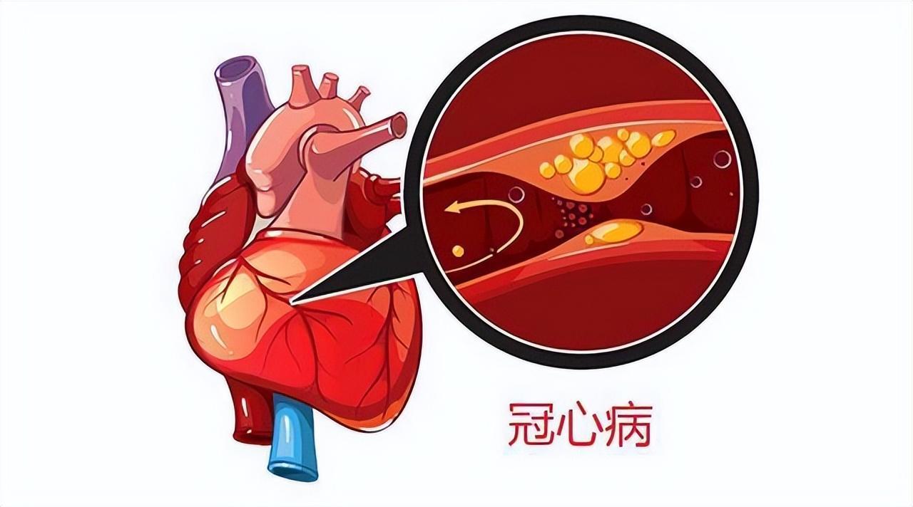 心肌缺血怎么办？症状、急救、预防及长期管理全攻略