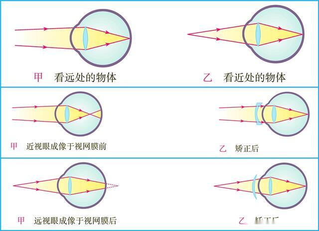 远视眼是怎么回事？深度解析远视眼成因、症状及矫正方法