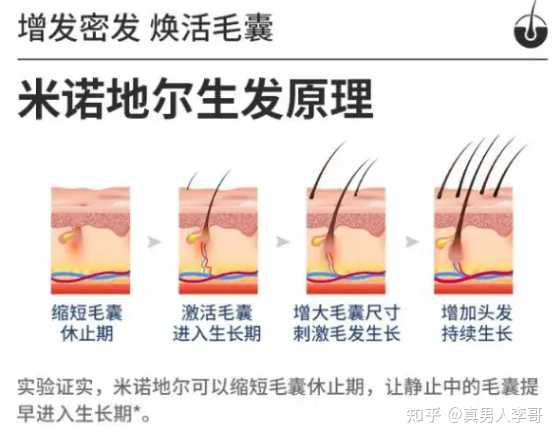 发际线高怎么办？改善发际线高的方法及潜在风险