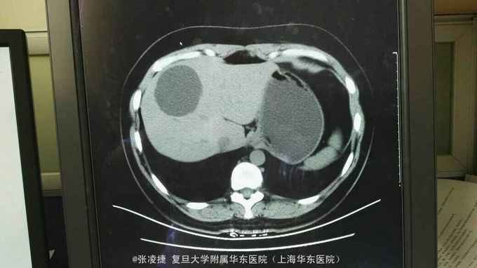 肝囊肿是怎么回事？探秘肝脏良性肿瘤的成因、症状及治疗