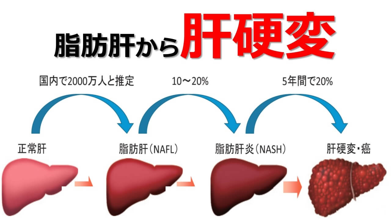 脂肪肝怎么治？深度解析治疗方法、预防措施及潜在风险