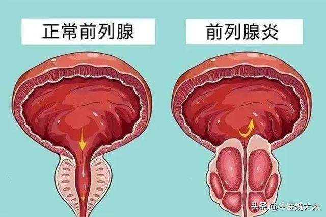 前列腺炎怎么治？从原因到治疗策略的全面分析