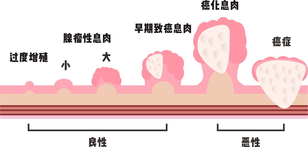 息肉是因为什么原因形成的？探秘息肉形成的多种因素及潜在风险