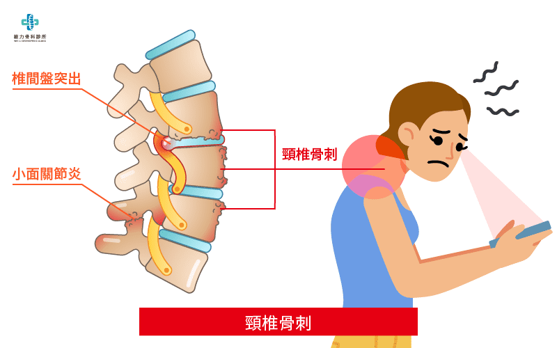 骨刺怎么治疗才能根除？深度解析骨刺治疗方法及有效预防策略