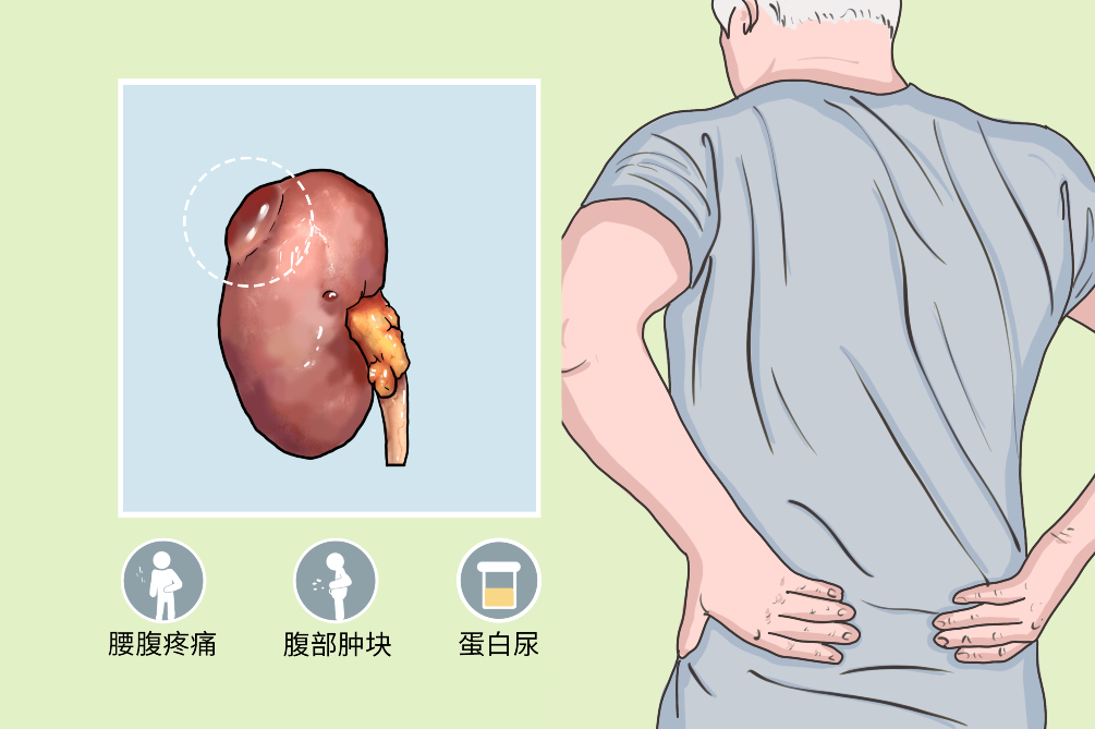 肾囊肿是怎么回事？全面解读肾囊肿的成因、症状、诊断和治疗