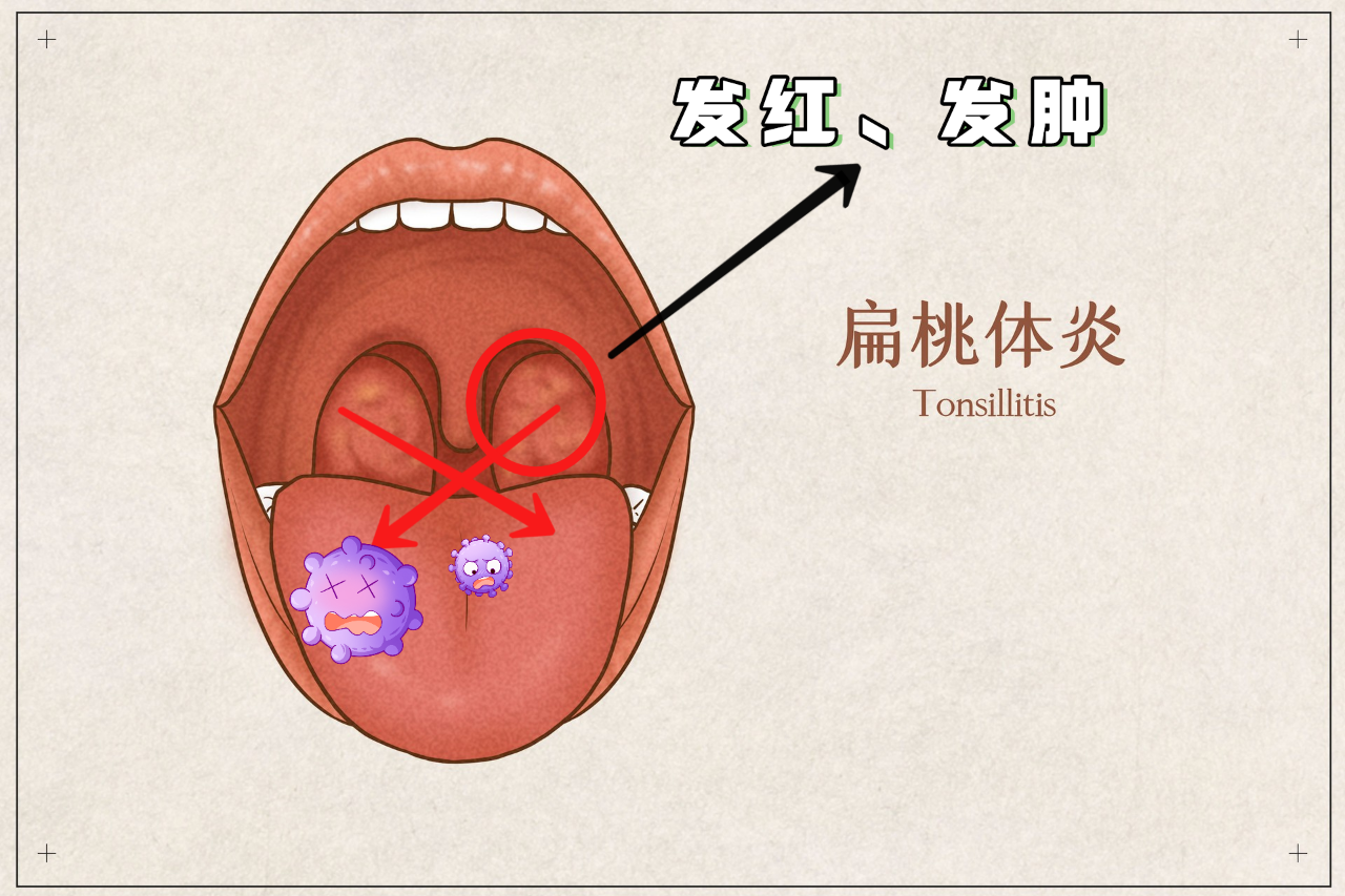 喉咙痛怎么治疗最快方法？快速缓解疼痛的实用指南