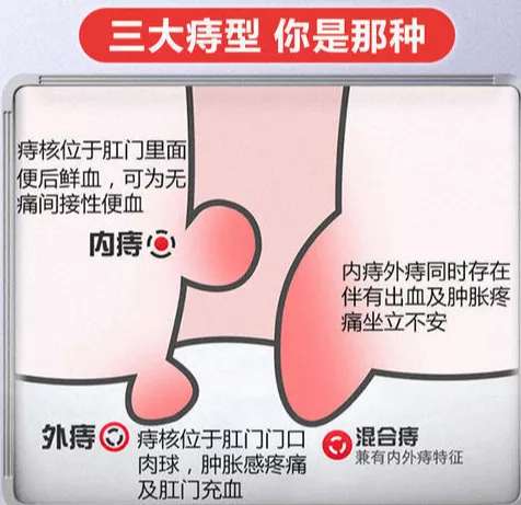 得了痔疮怎么办？权威指南：症状、治疗、预防及护理