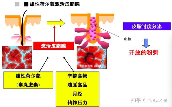 痤疮怎么治才能彻底根除？深度解析痤疮治疗方法及潜在风险