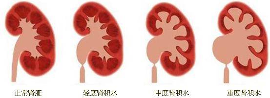 肾结石怎么办？全面解析治疗方法、预防措施及生活调理