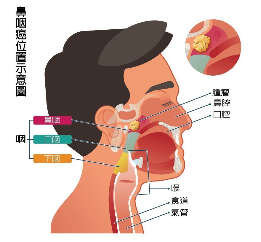 鼻咽癌是怎么引起的？探究致病因素及预防策略