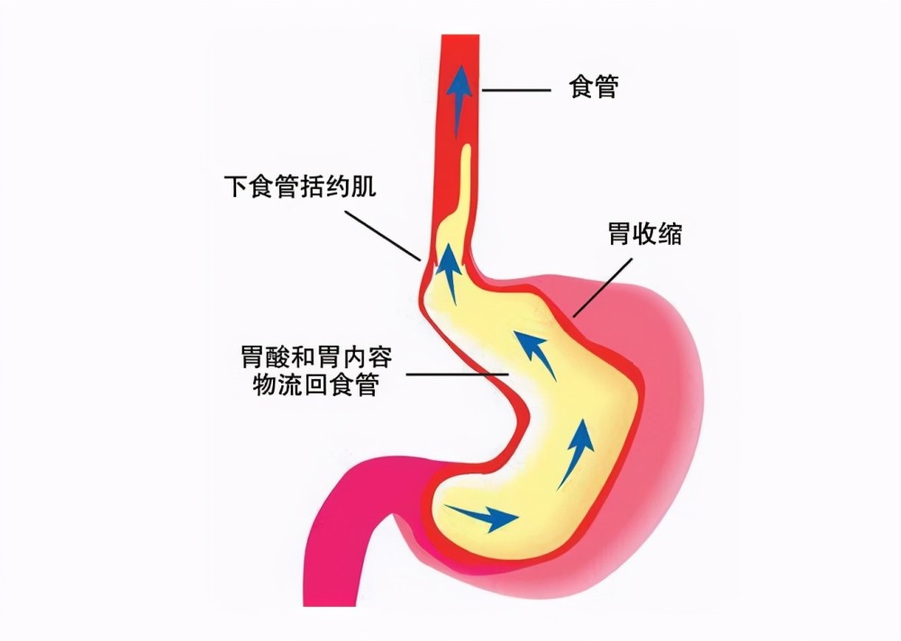 胃食管反流该怎么办？深度解析及应对策略