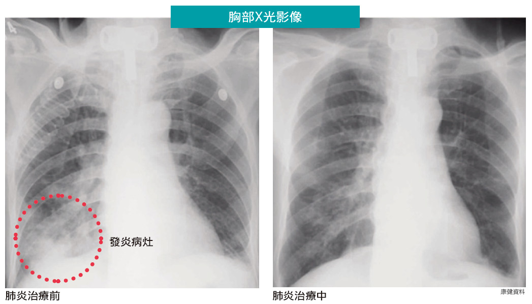 肺炎怎么治疗？详解不同类型肺炎的治疗方案及护理要点