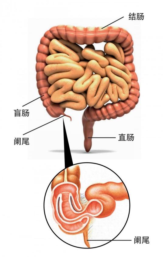 阑尾炎是怎么引起的？探秘阑尾炎的病因及预防措施