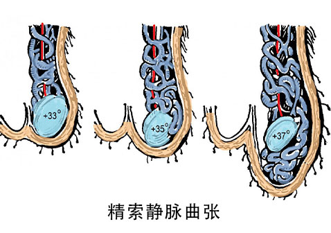 精索静脉曲张怎么治疗？有效疗法及术后护理全指南