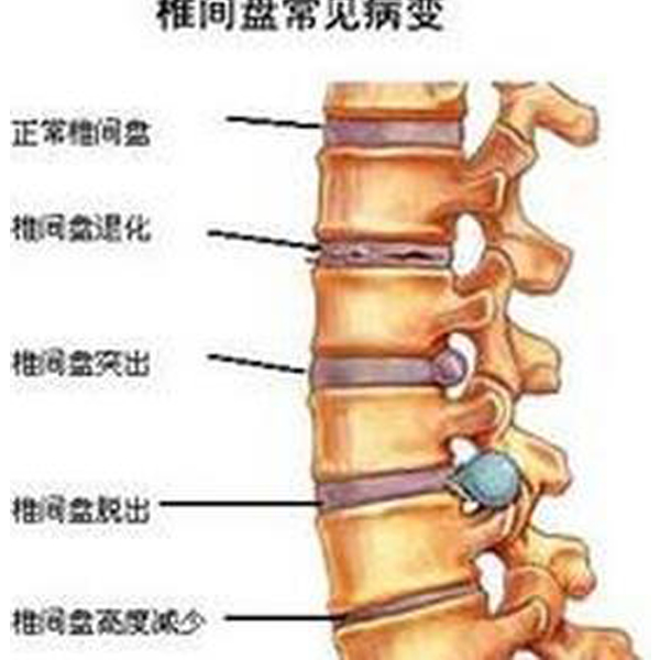 腰间盘突出压迫神经腿疼怎么办？权威解读及有效应对策略