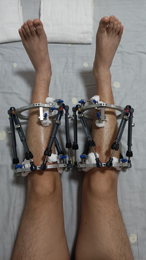 O型腿矫正全攻略：科学方法、有效技巧及潜在风险深度解析