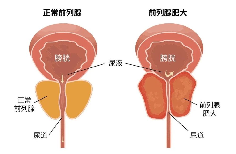 前再腺增生怎么治疗最好的方法：多种方法综合考虑