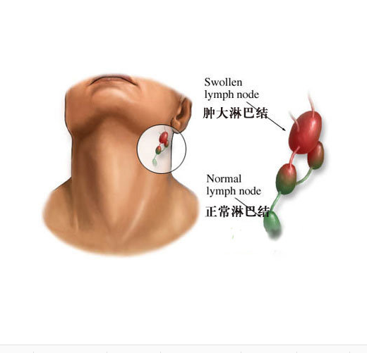 淋巴结节是怎么回事？全面解析淋巴结肿大原因、症状及治疗方法