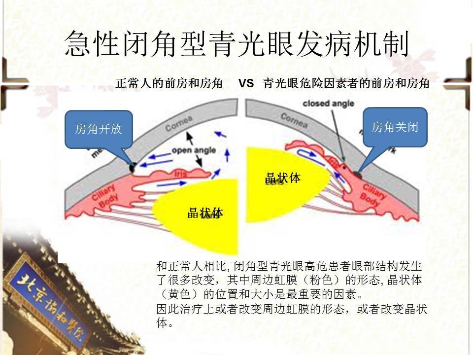 怎么判断自己是青光目？从症状诊断到治疗防治