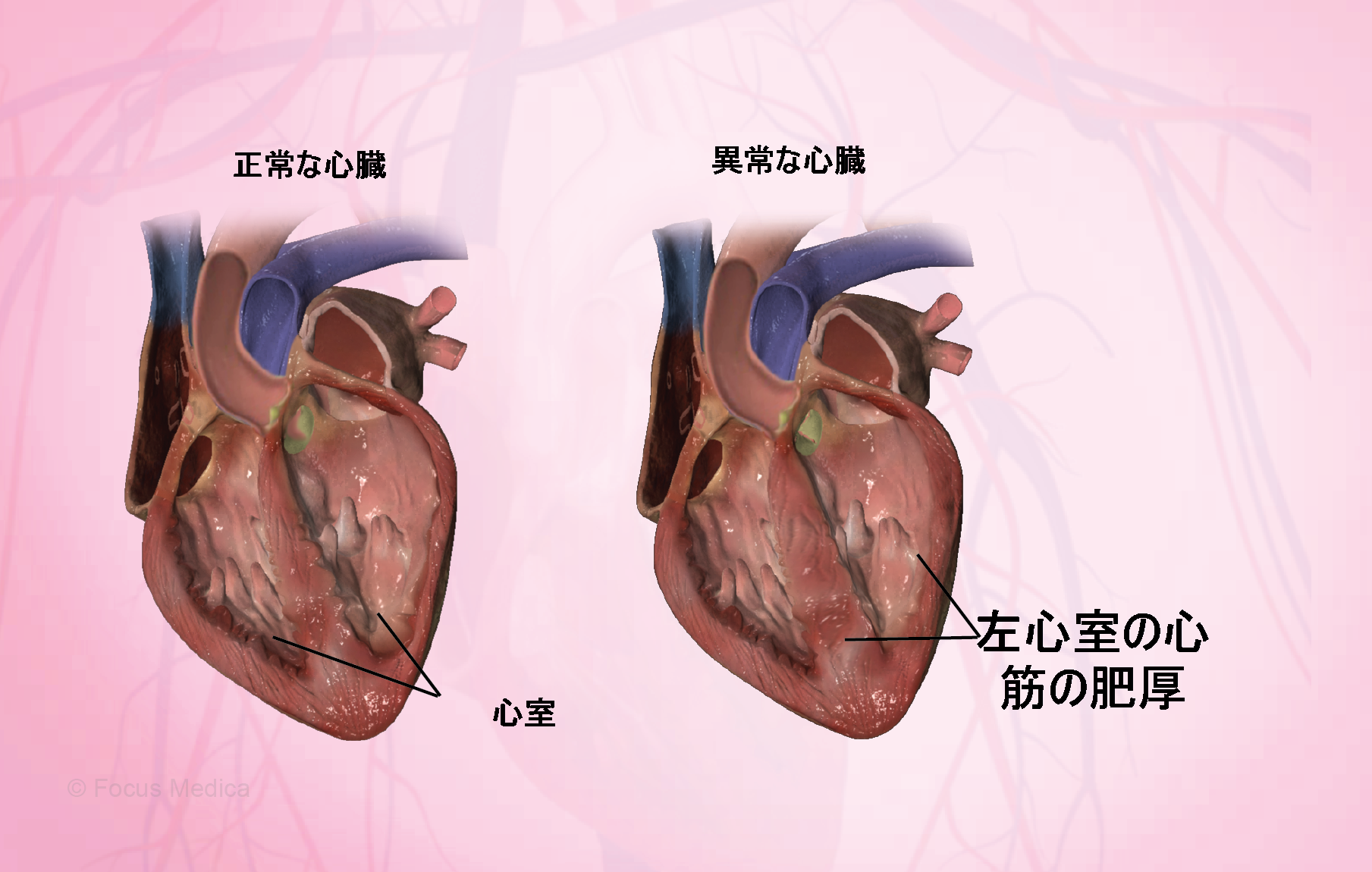 左心室肥大是怎么回事？能不能治好？深度解析及治疗方案