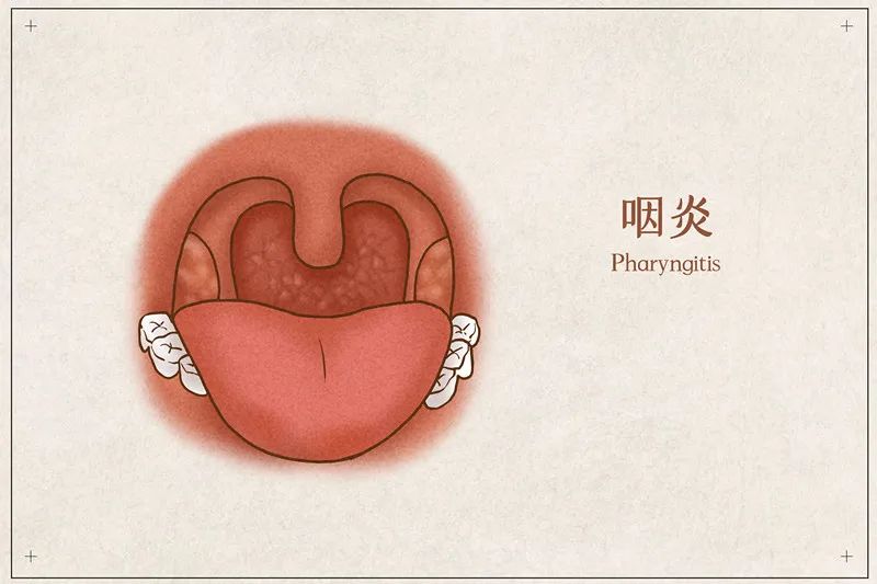 慢性咽喉炎怎么治疗才能彻底治好？深度解析及有效疗法