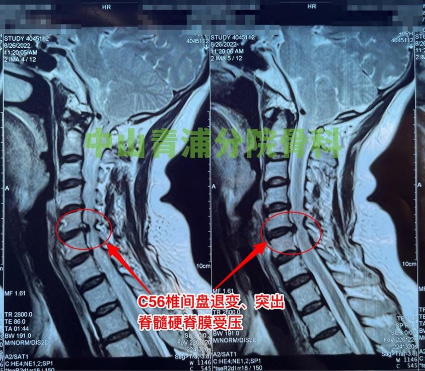 腰拉伤怎么办？快速缓解疼痛及恢复指南