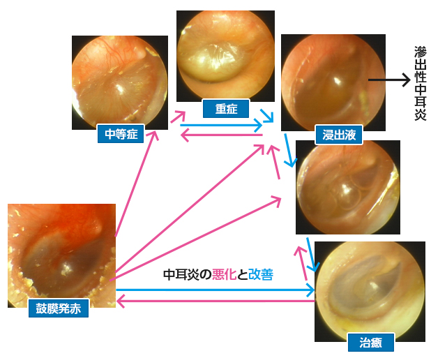 急性中耳炎怎么治疗？详解儿童及成人治疗方法及预防措施