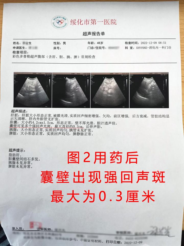 怎么治疗胆结石？详解胆结石治疗方法、风险及预防