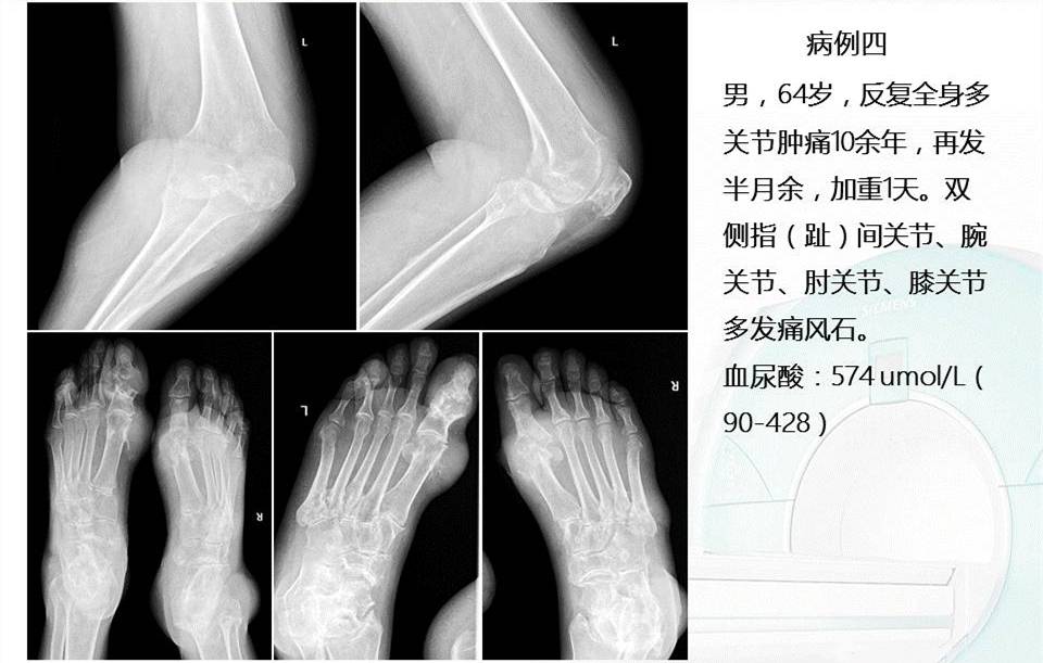 怎么判断是不是类风湿？关节疼痛的诊断与鉴别