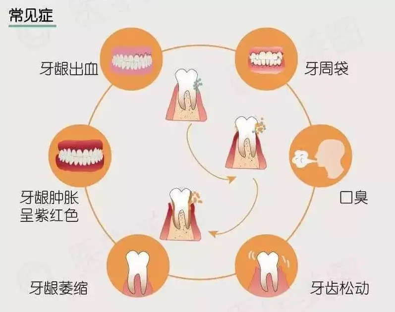 牙齿松动怎么治疗？深度解析及治疗方案指南