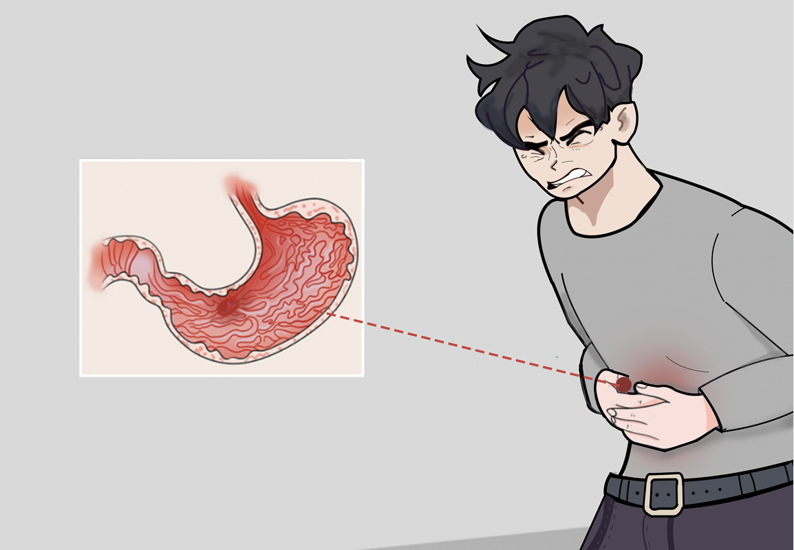 胃溃疡怎么治疗才能彻底治愈？深度解析及有效方案