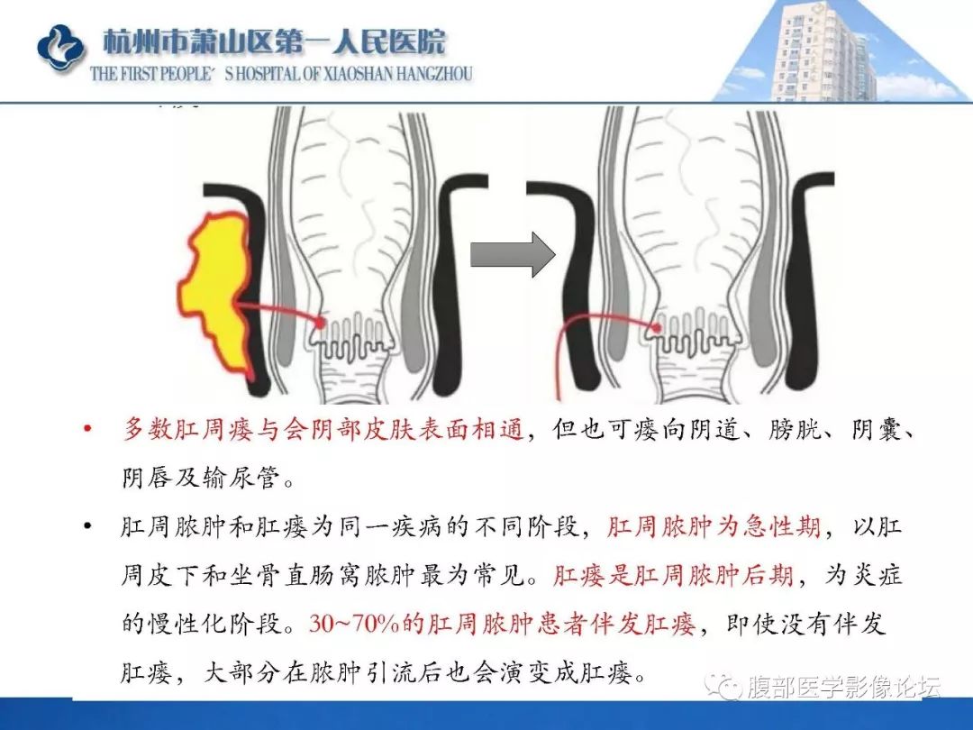 得了肛瘘不治会怎么样？深度解析肛瘘的危害及治疗