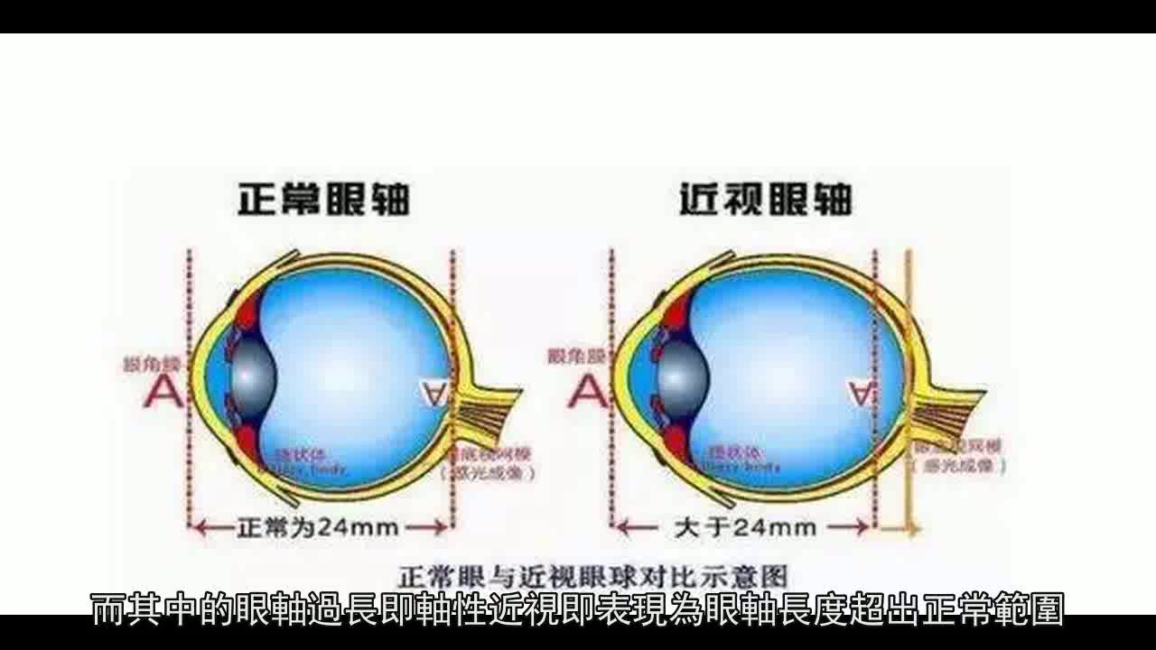 眼睛突出怎么办？探究眼球突出原因及有效改善方法