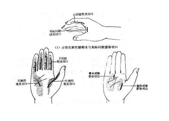 拇指腱鞘炎怎么样治疗最有效？详解治疗方法及恢复技巧