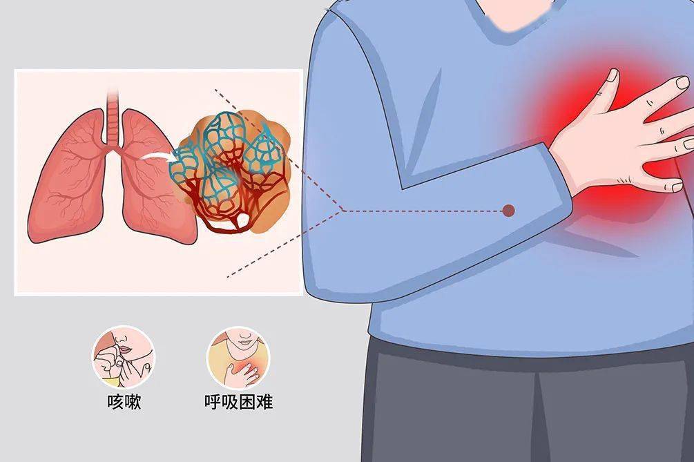 肺纤维化是怎么回事？深入解读肺纤维化成因、症状及治疗