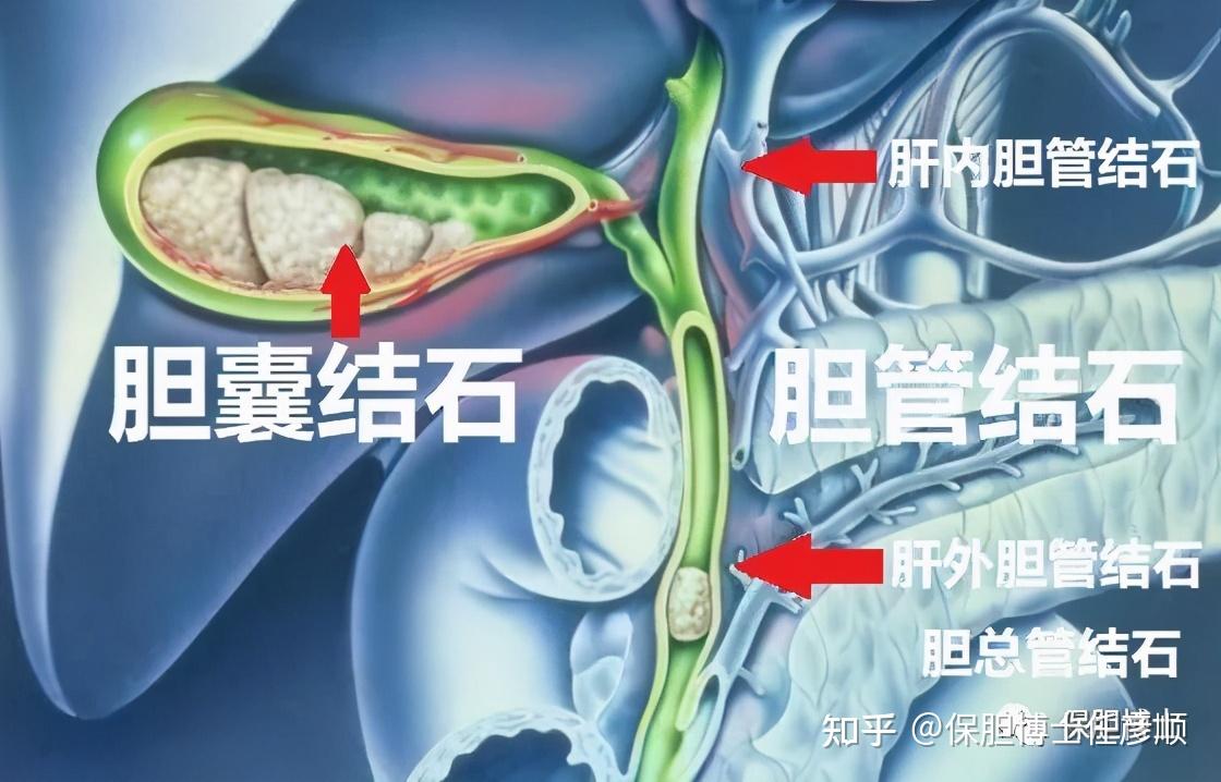 胆囊结石怎么治疗最好？探究最佳治疗方案及潜在风险