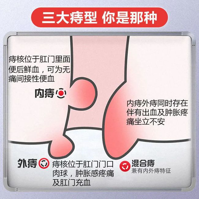 痔疮痒怎么办？缓解方法、预防措施及潜在风险深度解析