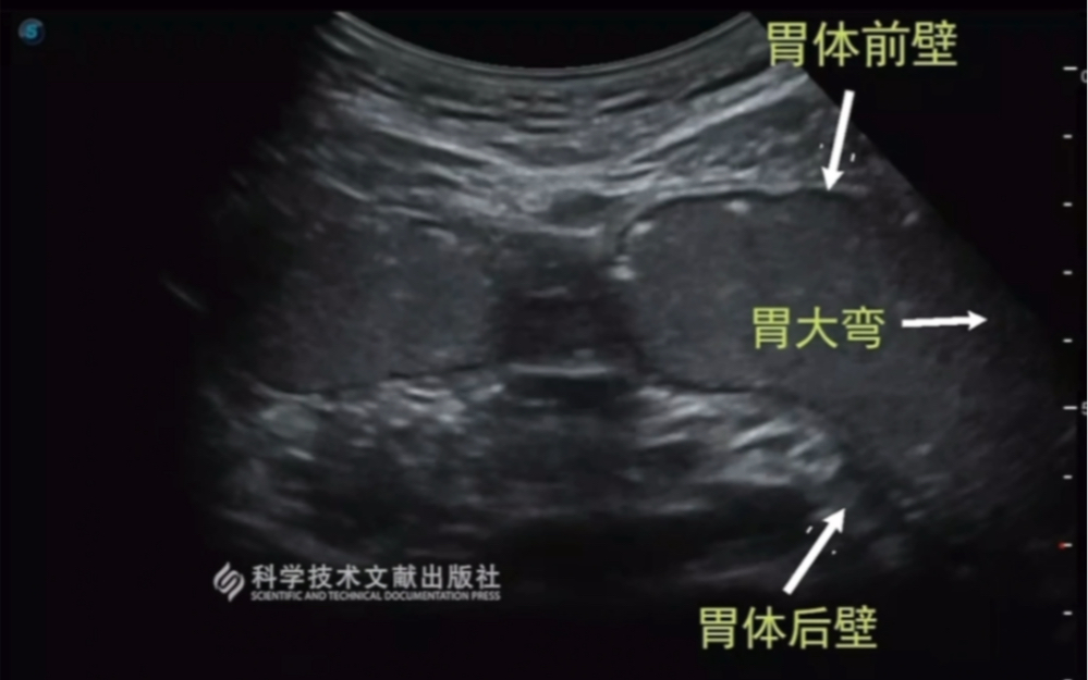 前列腺钙化灶怎么治疗？深度解析治疗方法及注意事项