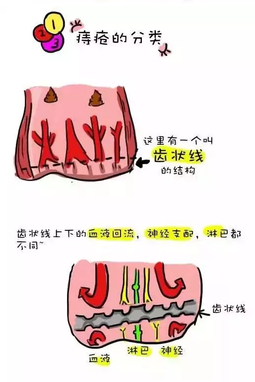 怎么判断自己长了内痔？内痔症状详解及自我诊断方法