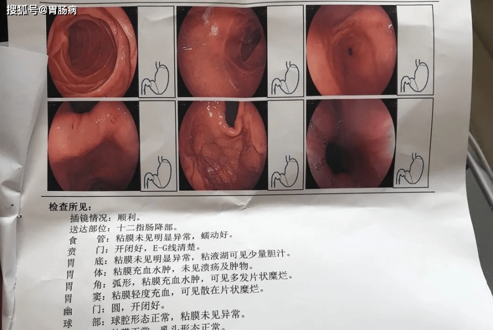 萎缩性胃炎是怎么形成的？探秘慢性胃部损伤的成因与防治