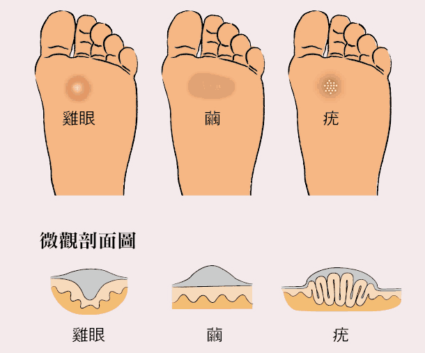 怎么处理鸡眼？有效方法、预防措施及潜在风险深度解析