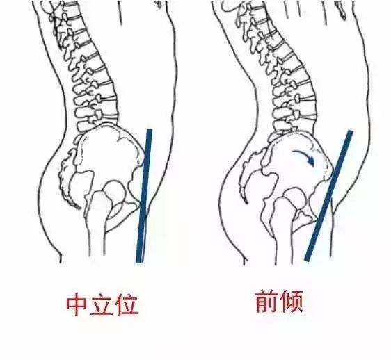 肋骨外翻怎么矫正？矫正方法、风险及注意事项详解