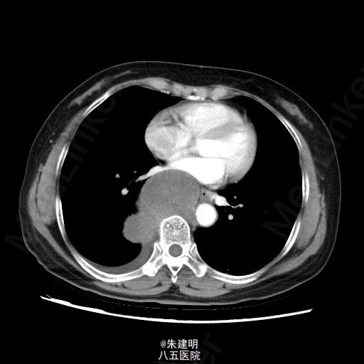 纵隔肿瘤怎么回事？详解纵隔肿瘤的成因、症状、诊断及治疗