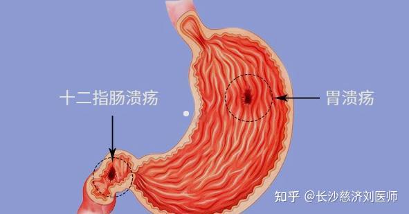 一吃东西就胃疼是怎么回事？探究胃痛背后的多种原因及应对方法