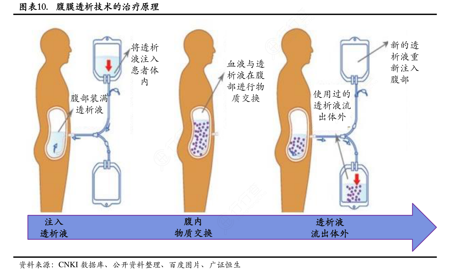 透析是怎么回事？详解透析治疗的原理、流程及风险