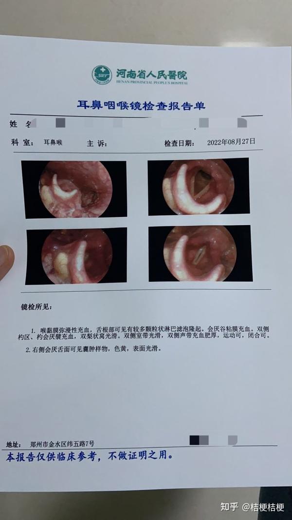 会厌囊肿怎么治疗最好？权威专家解读治疗方案及风险